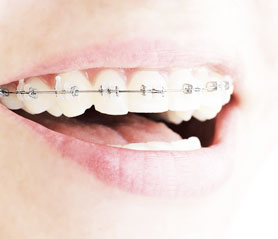 Invisalign - Invisible Braces - Los Angeles Dentist